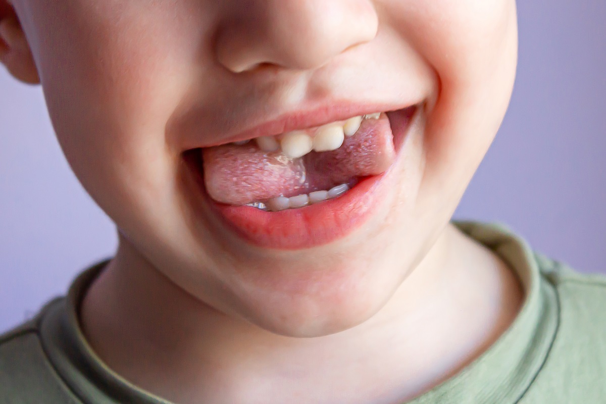 Bílé skvrny na zubech u dětí nepodceňujte. Upozorňují na tento problém
