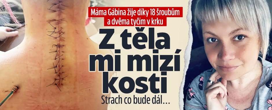 Banner ke žhavému tématu: Gábina žije díky 18 šroubům a tyčím v ...