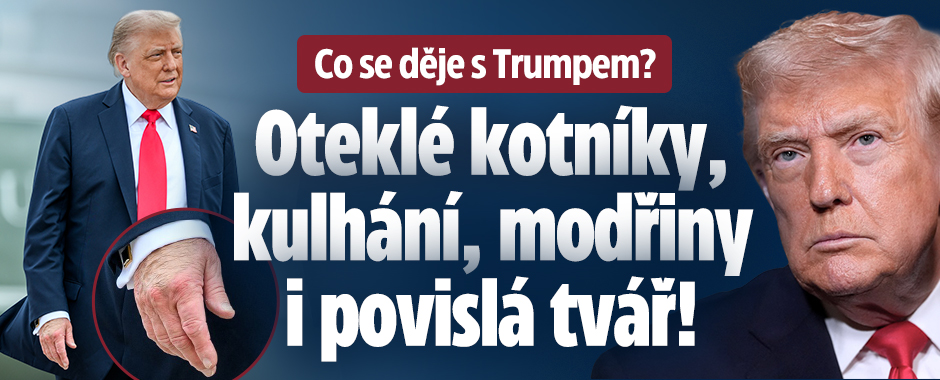 Banner ke žhavému tématu: Zdravotní trable Trumpa: Oteklé ...