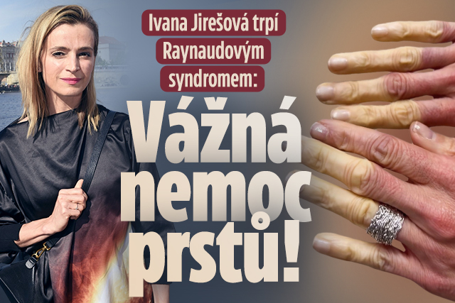 Banner ke žhavému tématu: Jirešová trpí Raynaudovým syndromem: ...