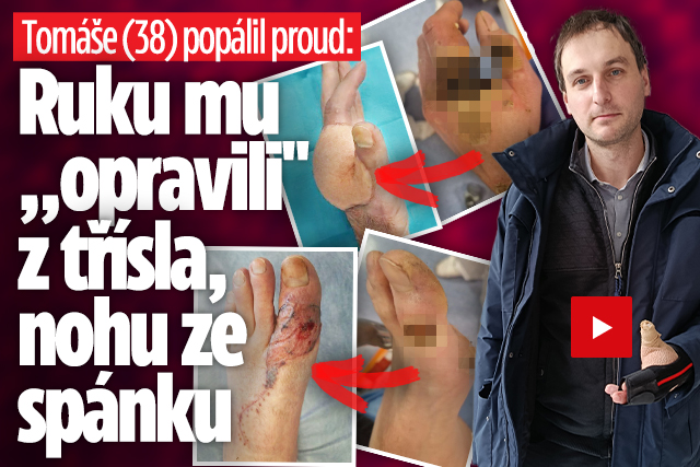 Banner ke žhavému tématu: Tomáše (38) popálil proud: Ruku mu ...