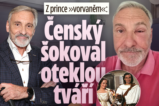 Z prince »vorvaněm«: Jan Čenský šokoval oteklou tváří!