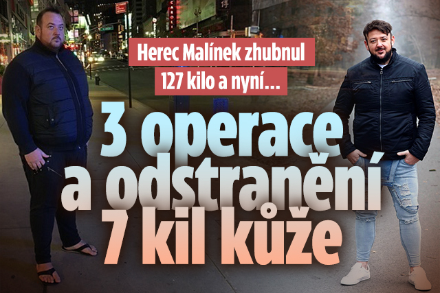 Banner ke žhavému tématu: Malínek zhubnul 127 kilo: 3 operace a ...