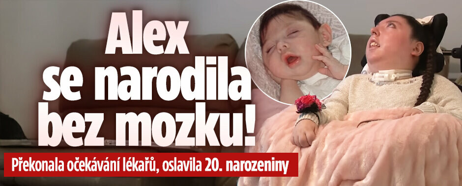 Alex se narodila bez mozku: Překonala očekávání lékařů, oslavila 20. narozeniny