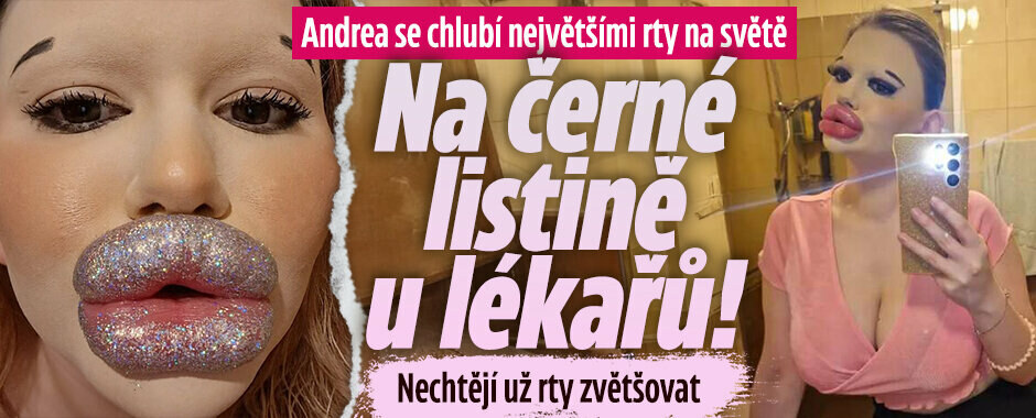 Andrea se chlubí největšími rty na světě: Na černé listině u lékařů! Nechtějí už rty zvětšovat