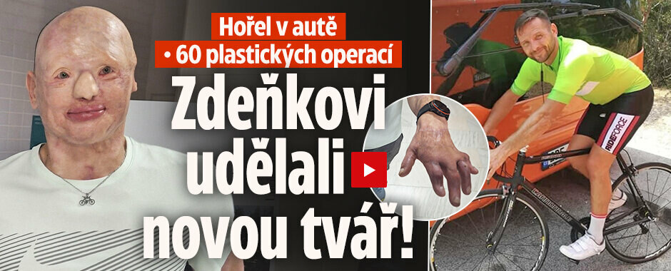 Zdeněk (50) málem uhořel v autě, přišel o obličej: Učí se žít s novou tváří!