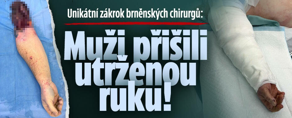 Unikátní zákrok brněnských chirurgů: Muži přišili utrženou ruku!