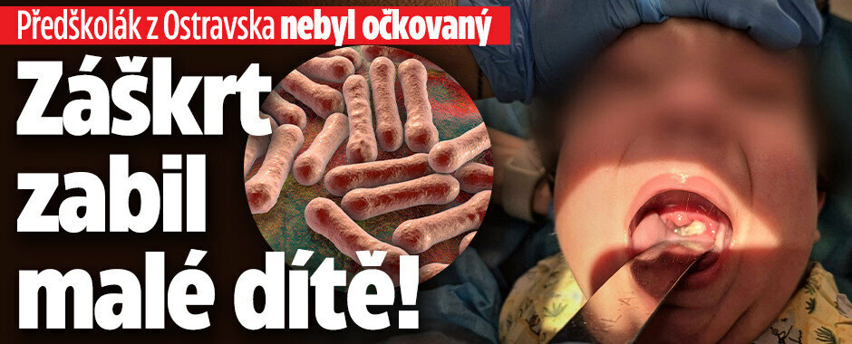 Záškrt zabil malé dítě! Předškolák z Ostravska nebyl očkovaný